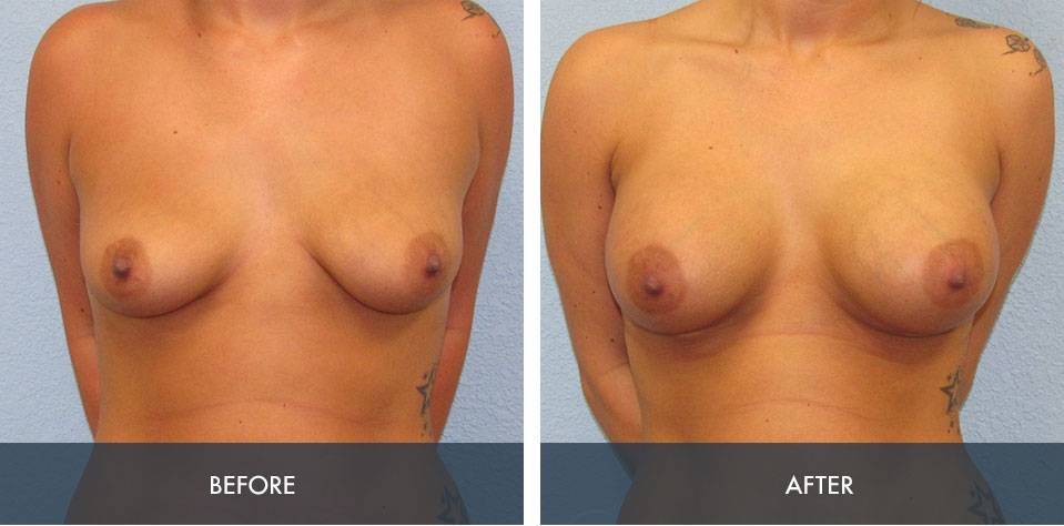 breast augmentation 5a