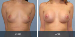 breast augmentation 7a