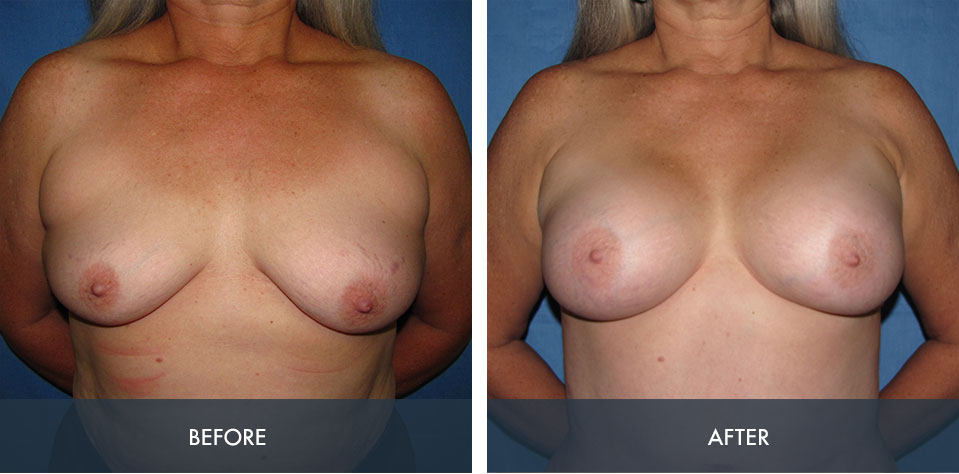 breast augmentation 8a