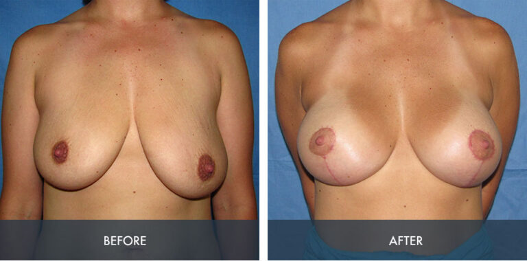 Toner for breast enlargement archives