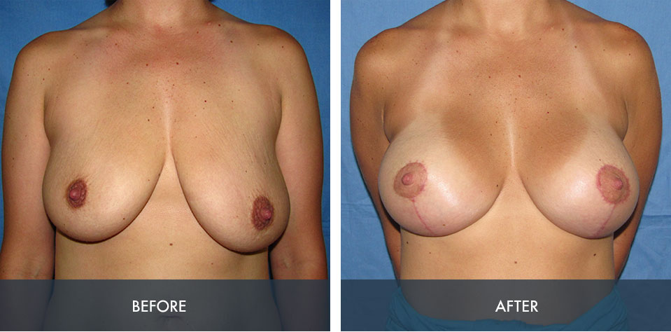 breast augmentation lift 4a