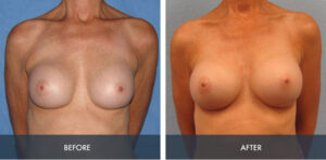 breast implant exchange 1a