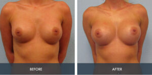 breast implant exchange 3a