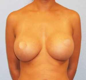 Breast Augmentation - After
