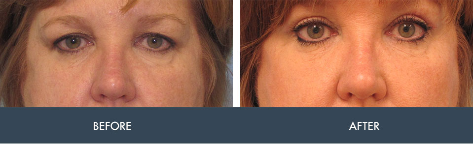 blepharoplasty eyelid surgery before and after photos