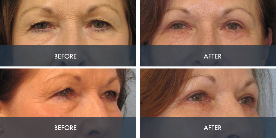 before and after eyelid surgery photos
