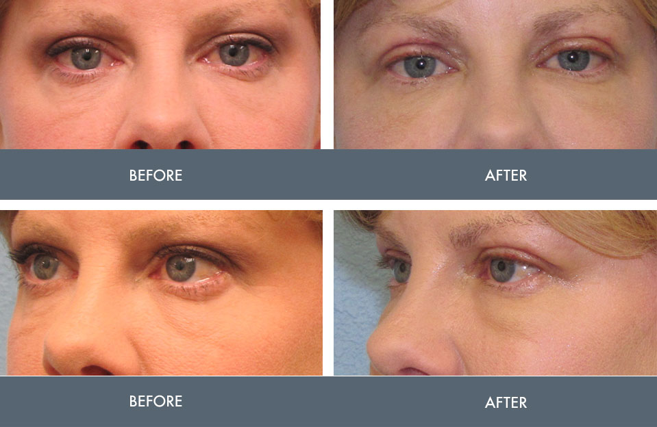 before and after blepharoplasty eyelid surgery