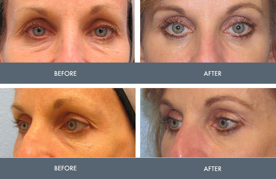 blepharoplasty before and after images