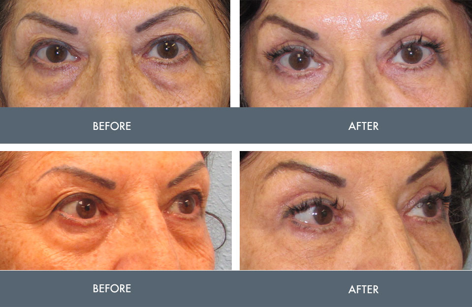 blepharoplasty surgery results
