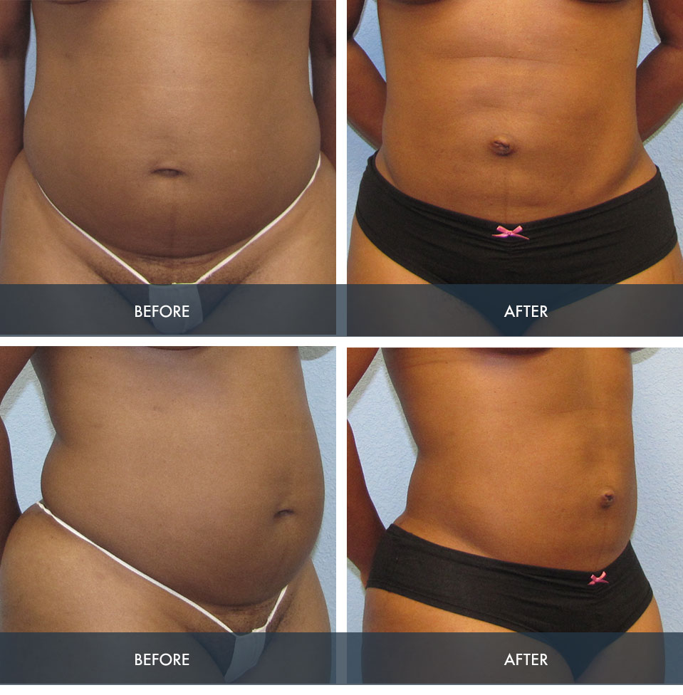 Liposuction Gallery in Pearland & Houston, TX