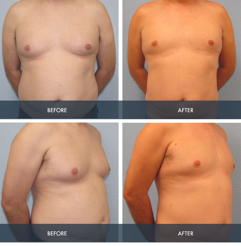 Liposuction for Men Houston TX  Male Liposuction – Houston Lipo