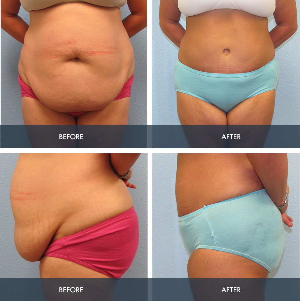 Amazing tummy tuck before and after surgery photos 4375