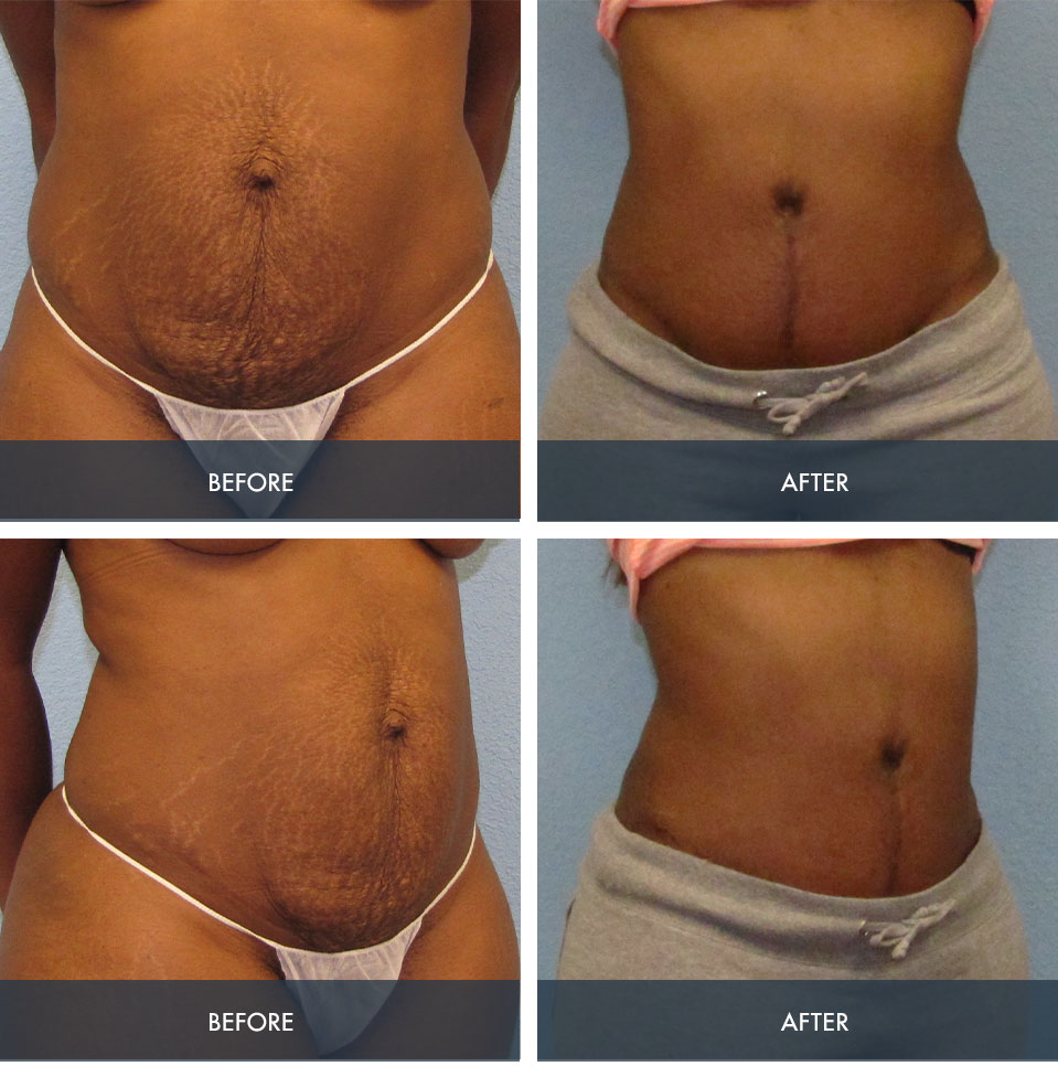 Before & After Tummy tuck with lipo to flanks and thighs - Dr
