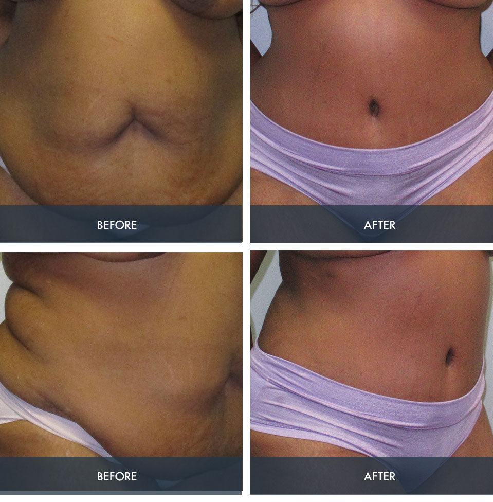 Tummy Tuck Before and After Gallery Houston Pearland SunCoast Plastic Surgery photo