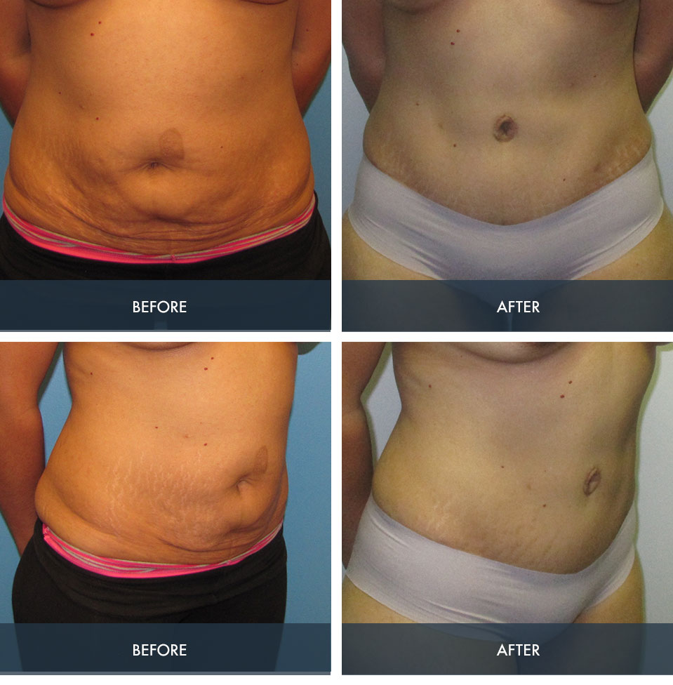 Abdominoplasty and Tummy Tuck Before and After Results
