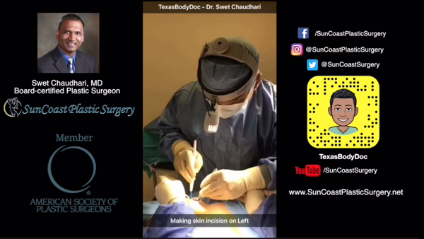 A Houston plastic surgeon in scrubs makes a skin incision on a patient in an operating room. On the left, there’s a photo of Dr. Swet Chaudhari with his credentials and the SunCoast Plastic Surgery logo. Social media handles appear on the right.