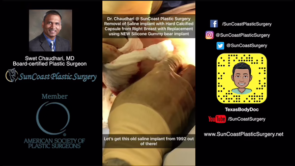 A promotional image for SunCoast Plastic Surgery in Houston features plastic surgeon Dr. Swet Chaudhari, contact details, social media handles, the American Society of Plastic Surgeons logo, and a video still of a saline implant removal surgery.