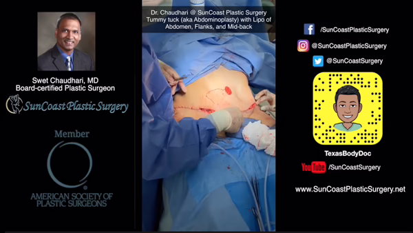 A photo collage features Dr. Chaudhari, a board-certified plastic surgeon, performing tummy tuck plastic surgery, alongside SunCoast Plastic Surgery’s social media info with logos and a cartoon avatar.