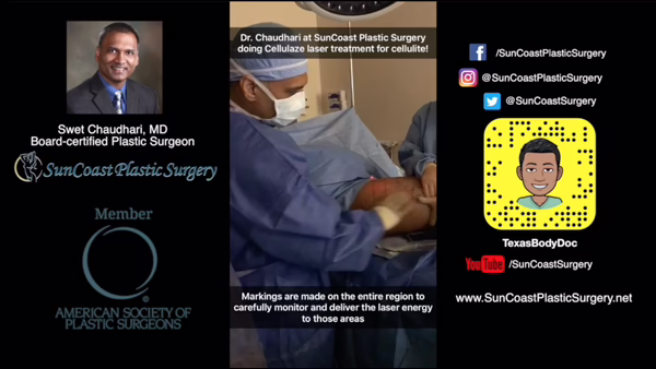 A plastic surgeon in scrubs performs a Cellulaze laser procedure on a patient’s leg. Text about Dr. Chaudhari, SunCoast Plastic Surgery, and social media links appear on both sides of the image.