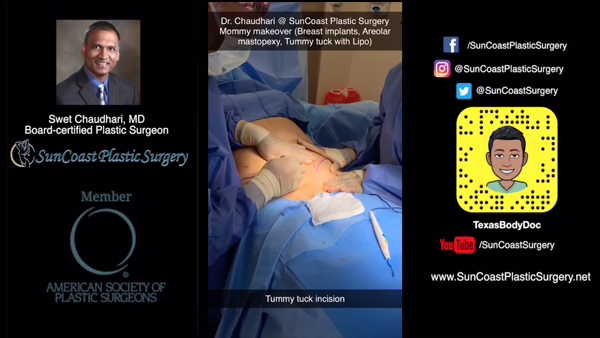 A plastic surgery ad for SunCoast features Dr. Chaudhari’s photo, credentials, and social media links on the sides. The center highlights a mommy makeover with a plastic surgeon performing a tummy tuck incision.