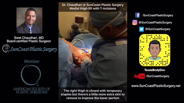 A surgeon performs a medial thigh lift with T-incisions in the SunCoast plastic surgery operating room. Text explains the procedure, and there are logos, social media handles, and a photo of Dr. Chaudhari on the left.