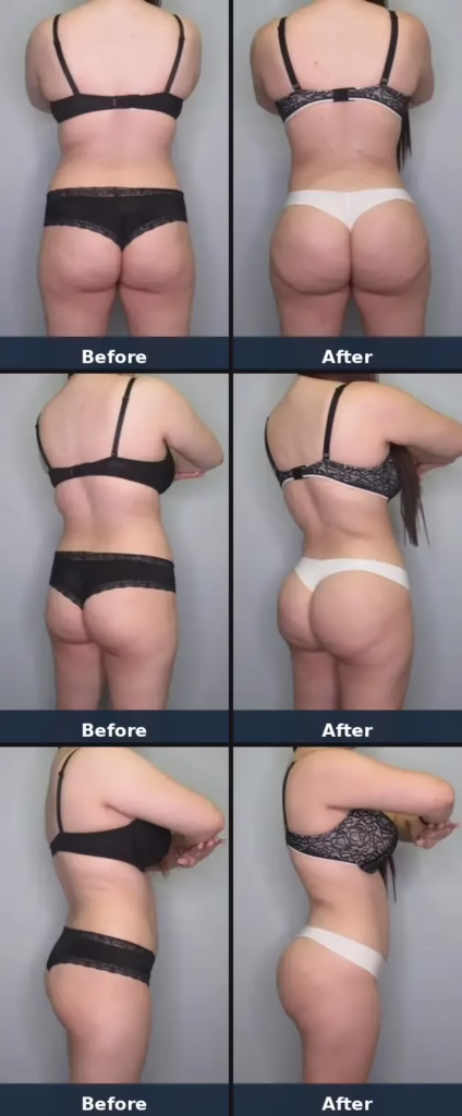 20 yo mother of one (5'5" 167lbs) who underwent Lipo360 BBL and had a total of 4.3L removed and 660mL transplanted into each buttock. Photos are 6mo post-op.