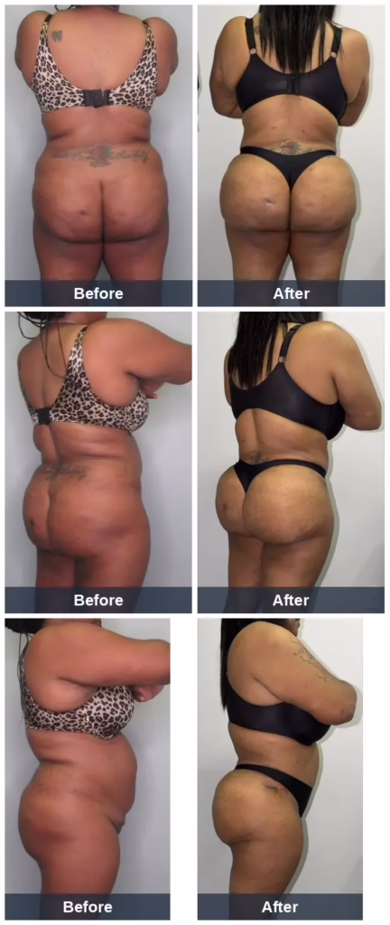 40 yo female (5'1" 177lbs) who previously had a Tummy tuck, underwent her 2nd round of Lipo360 BBL and had a total of 6L removed and 800mL transplanted into each buttock the first round. Then had 150mL transplanted into the left inferior buttock and 200mL into the right inferior buttock along with 200mL transplanted into both hips the second round. Photos are 3yrs post-op.