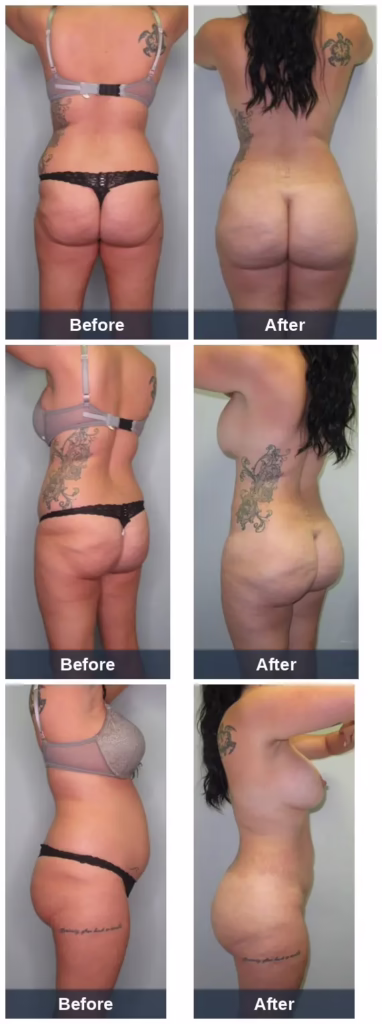 30 yo female (6'0" 194lbs) who underwent Lipo360 BBL and had a total of 5550mL removed. 800mL was transplanted into the right buttock and 950mL into the left buttock, along with 200mL transplanted into both anterior hips. Photos are 8mo post-op.
