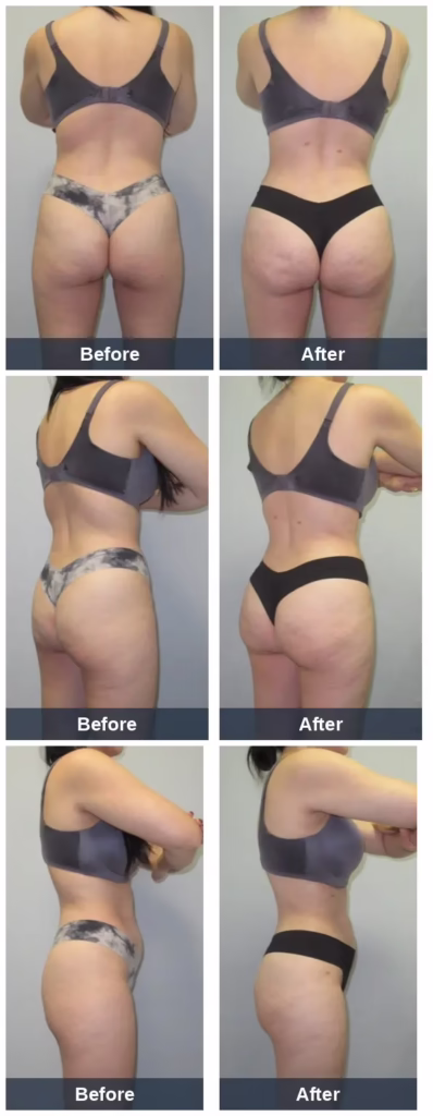 38 yo mother of four (5'3" 124lbs) who underwent Lipo360 BBL and had 3.4L removed and 550mL transplanted into each buttock. Photos are 1mo post-op.
