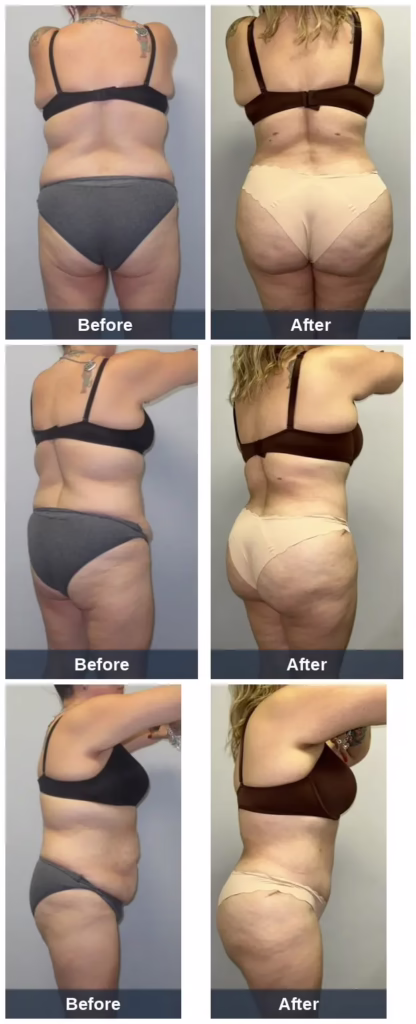 42 yo female (5'1" 168lbs) who lost 50lbs, underwent Lipo360 BBL and had 3850mL removed and 1300mL transplanted into each buttock. Photos are 8mo post-op.