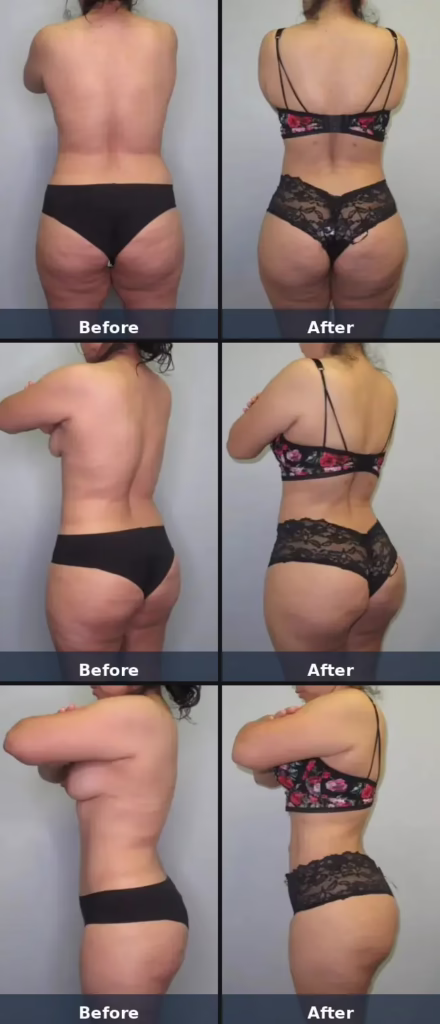 39 yo mother who had 7 pregnancies and 5 kids (5'5" 148lbs) who underwent Lipo360 BBL, after having a Tummy Tuck 2yrs prior, had 4250mL removed and 600mL transplanted into each buttock. Photos are 9mo post-op.