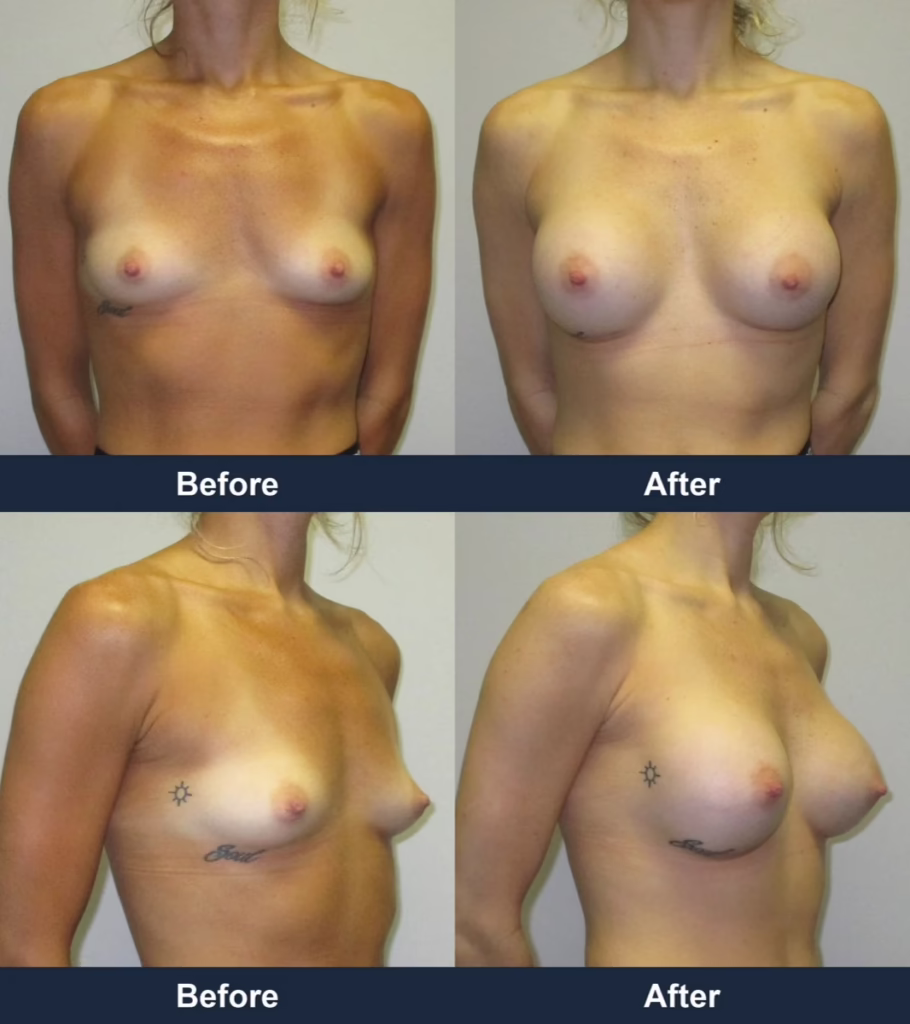 Breast Augmentation - Before and After Images with Dr. Chaudhari