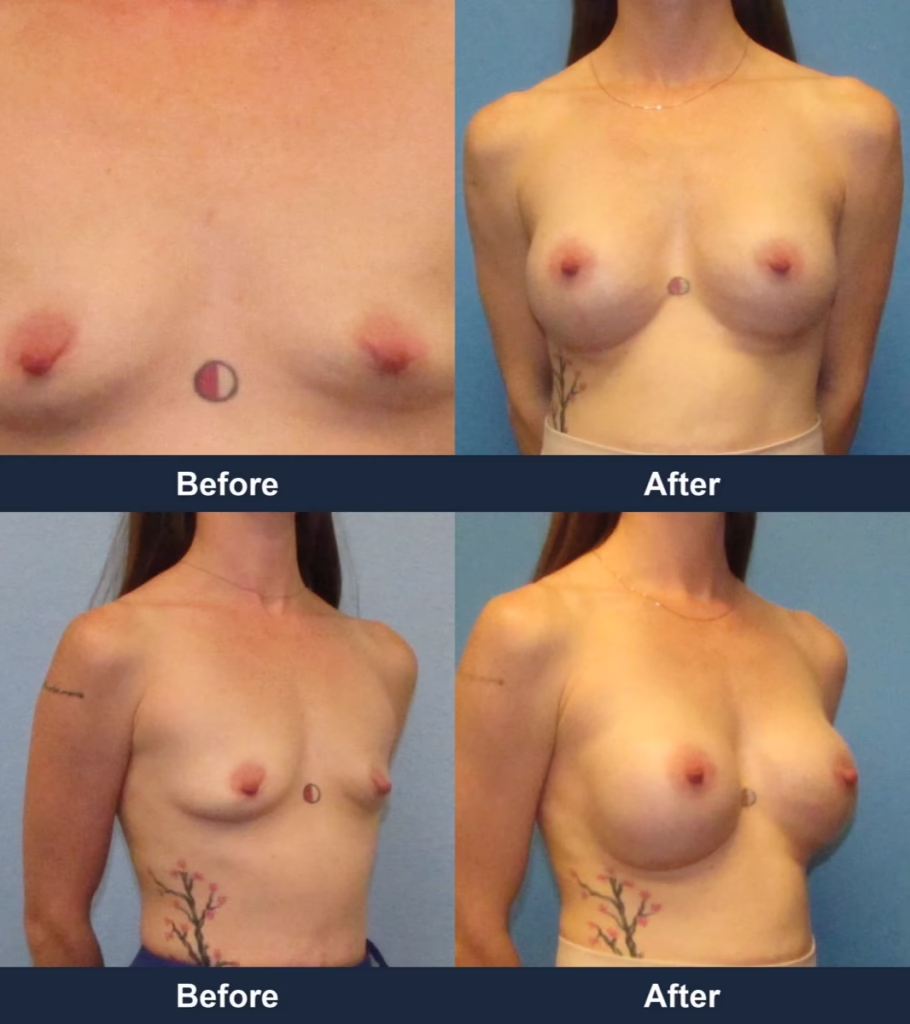 Breast Augmentation - Before and After Images with Dr. Chaudhari