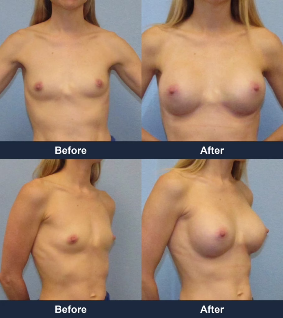 Breast Augmentation - Before and After Images with Dr. Chaudhari