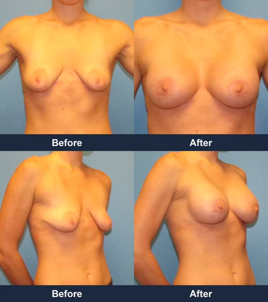 Breast Augmentation - Before and After Images with Dr. Chaudhari