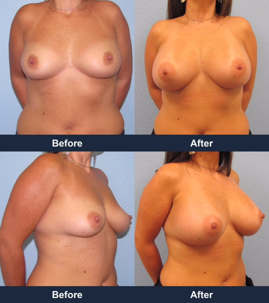 Breast Augmentation - Before and After Images with Dr. Chaudhari
