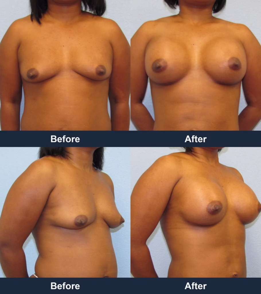 Breast Augmentation - Before and After Images with Dr. Chaudhari