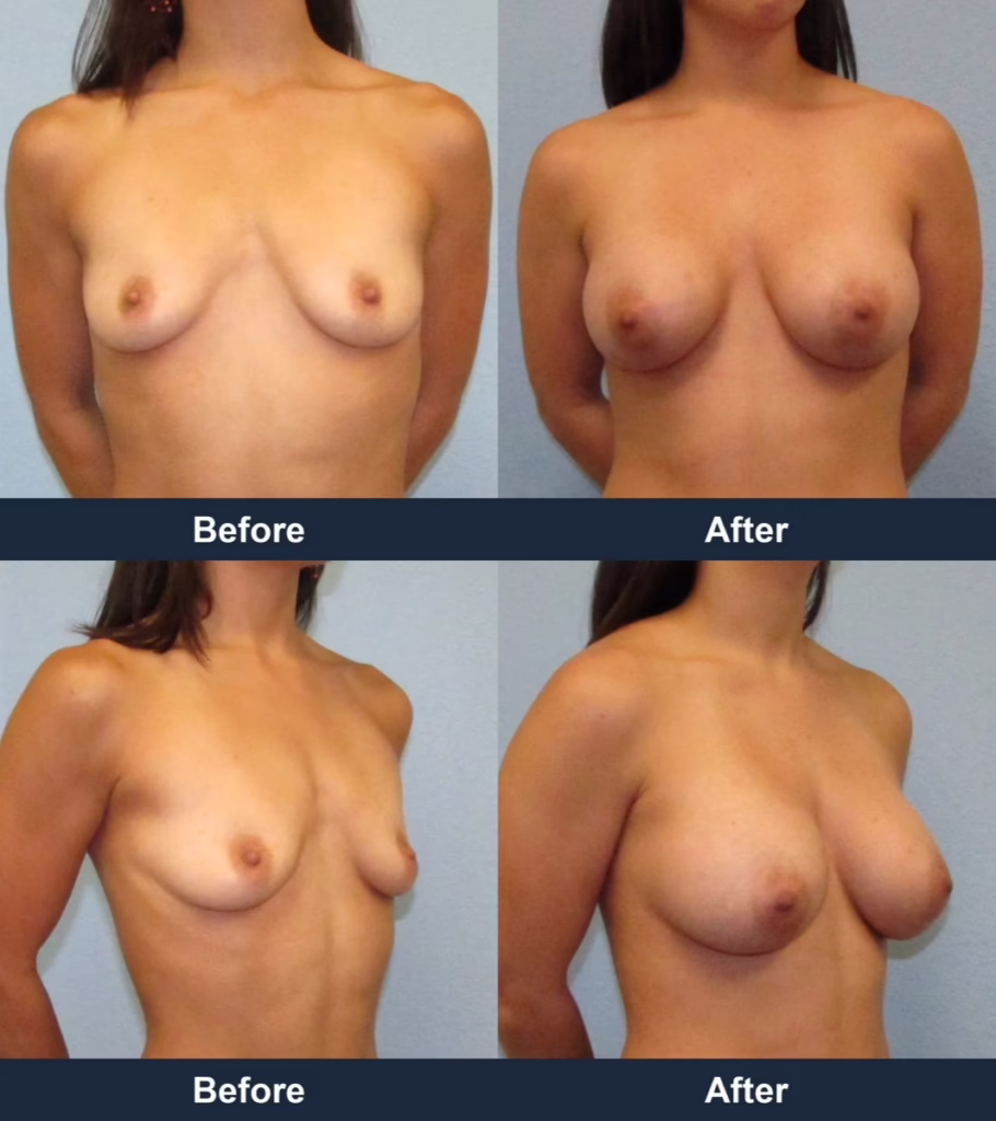 Breast Augmentation - Before and After Images with Dr. Chaudhari