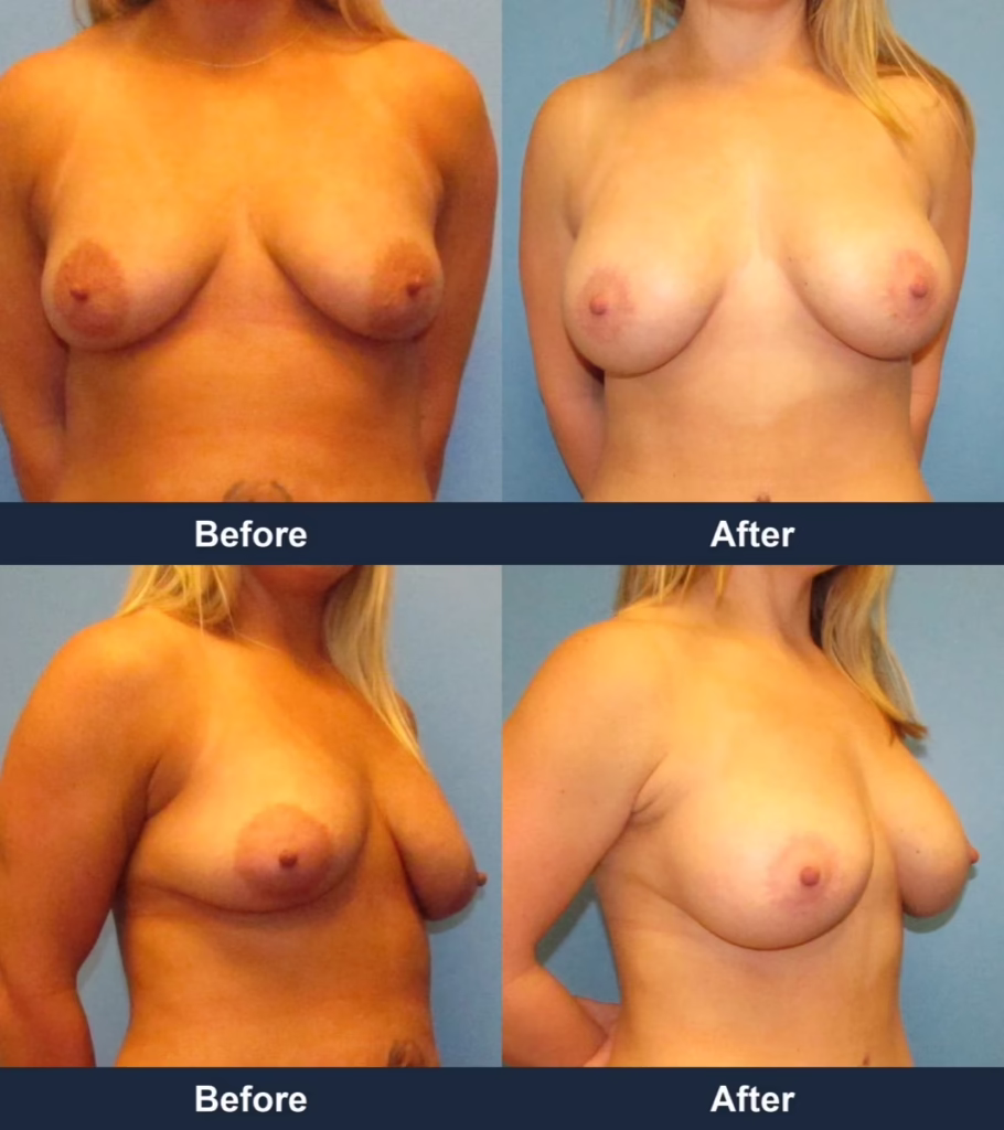 Breast Augmentation - Before and After Images with Dr. Chaudhari