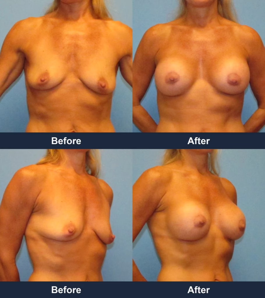 Breast Augmentation - Before and After Images with Dr. Chaudhari