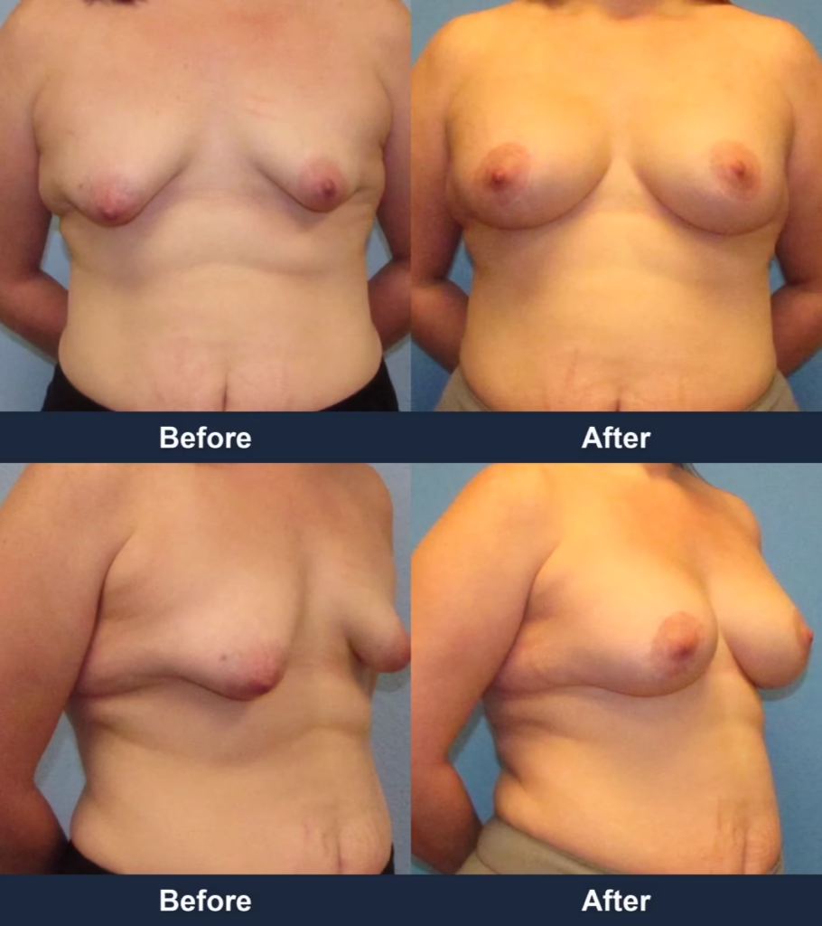 Breast Augmentation - Before and After Images with Dr. Chaudhari