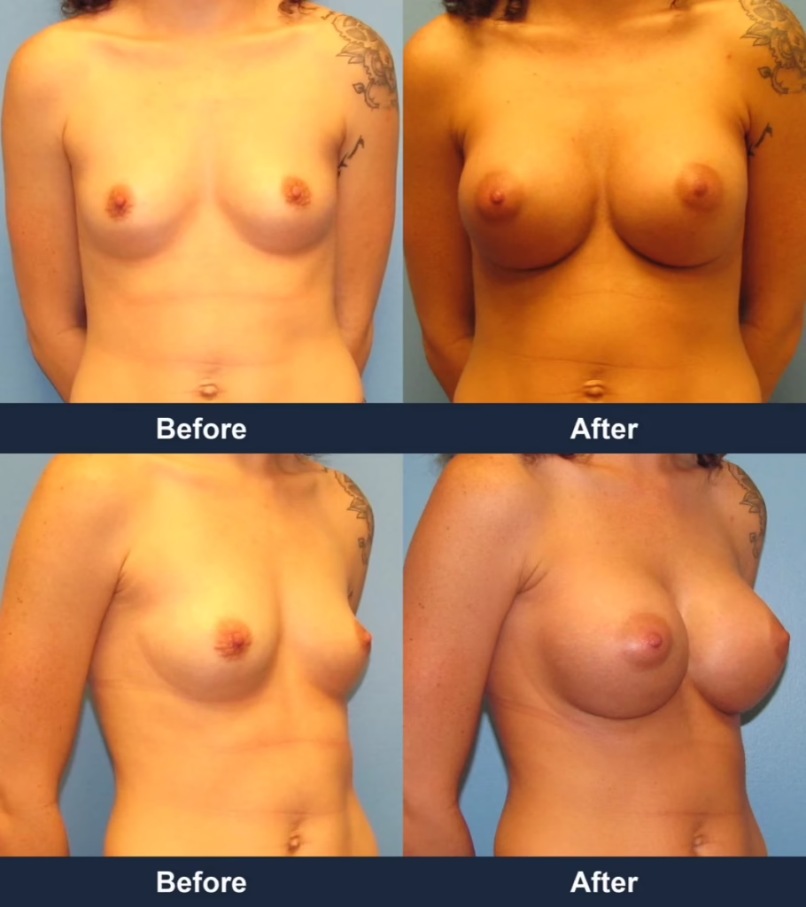 Breast Augmentation - Before and After Images with Dr. Chaudhari