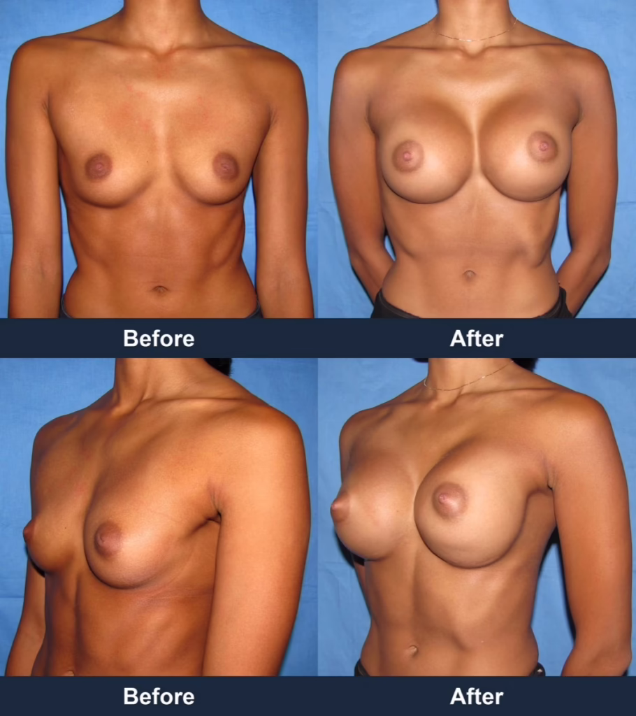 Breast Augmentation - Before and After Images with Dr. Chaudhari