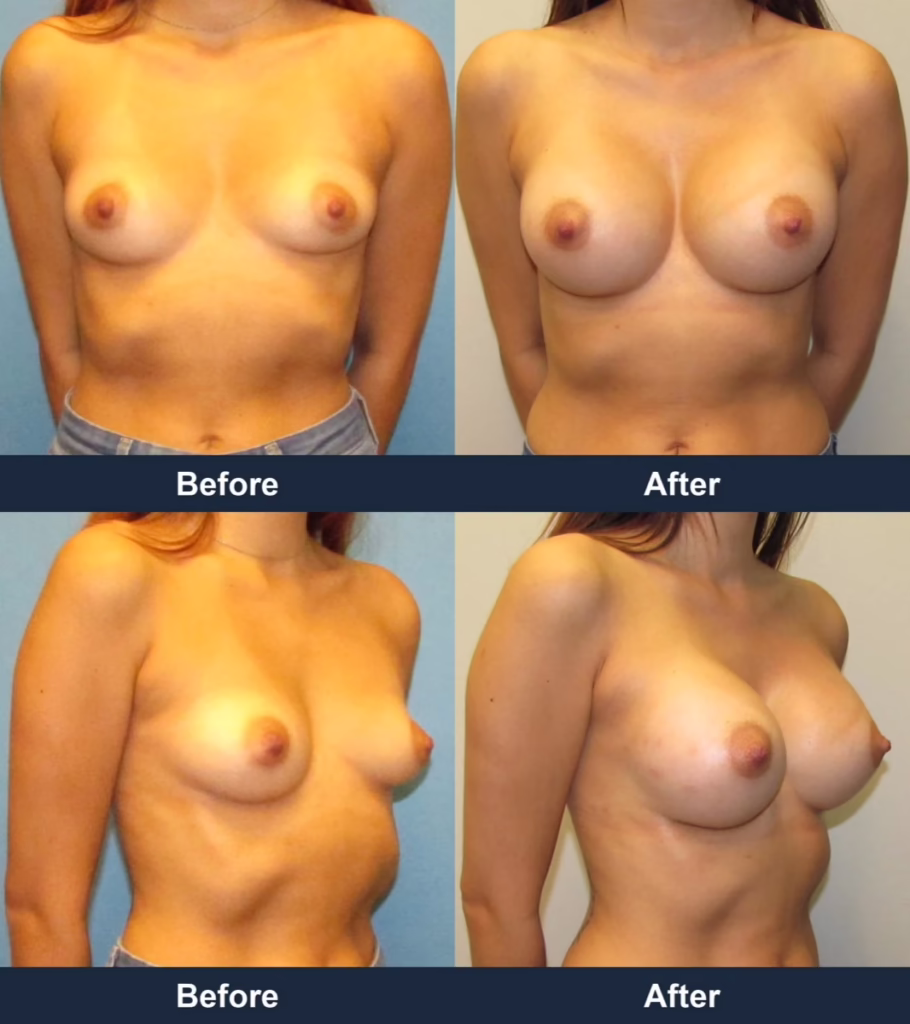 Breast Augmentation - Before and After Images with Dr. Chaudhari