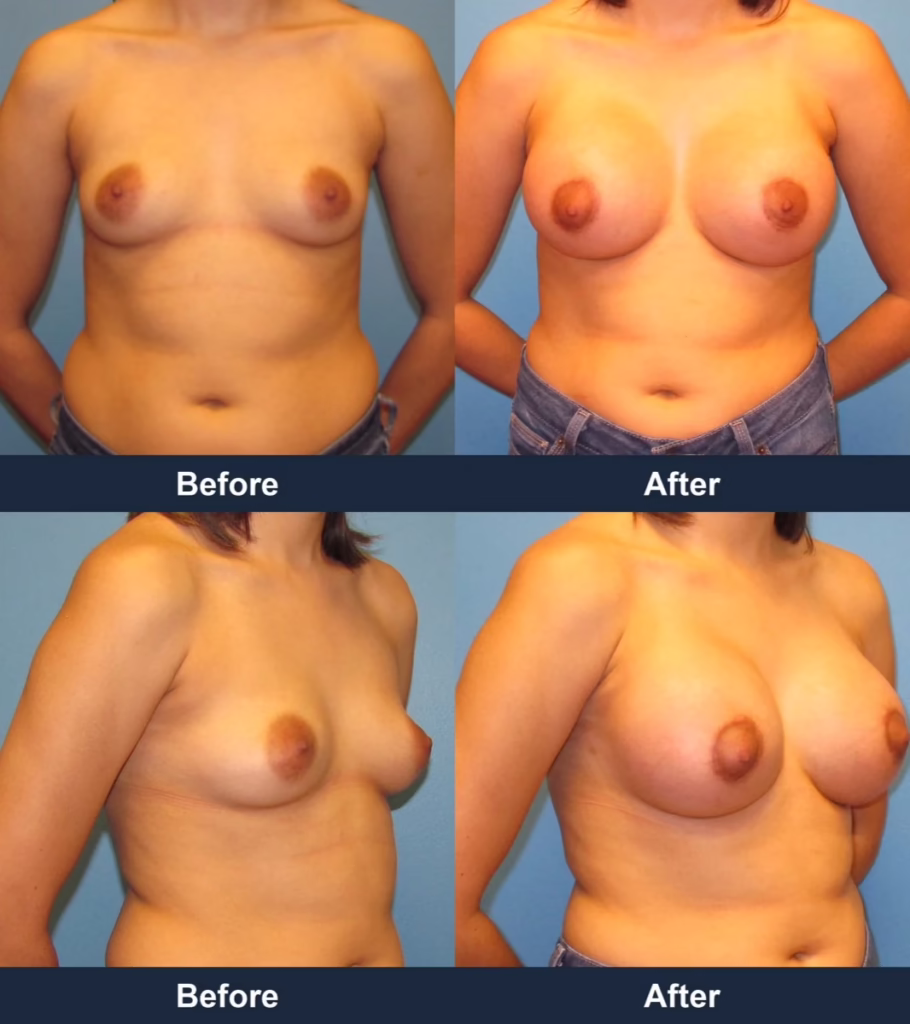 Breast Augmentation - Before and After Images with Dr. Chaudhari