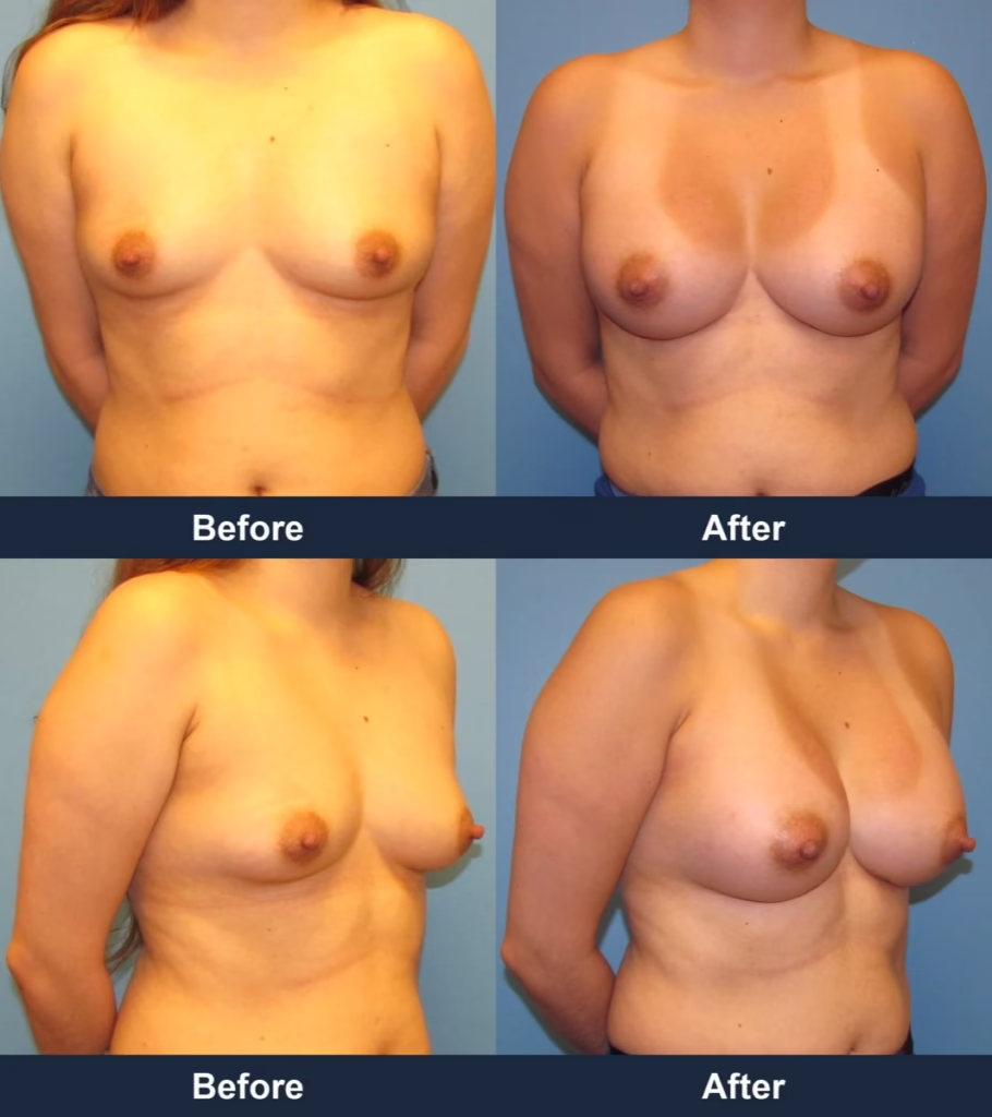 Breast Augmentation - Before and After Images with Dr. Chaudhari
