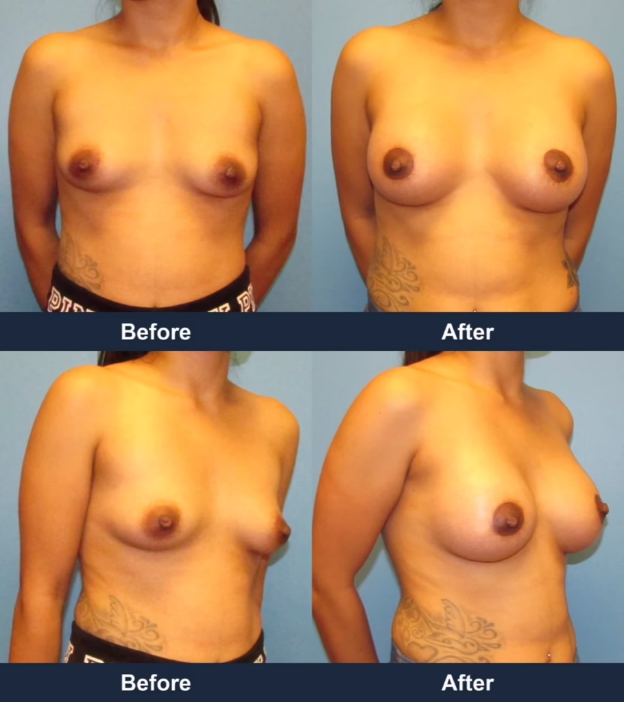 Breast Augmentation - Before and After Images with Dr. Chaudhari