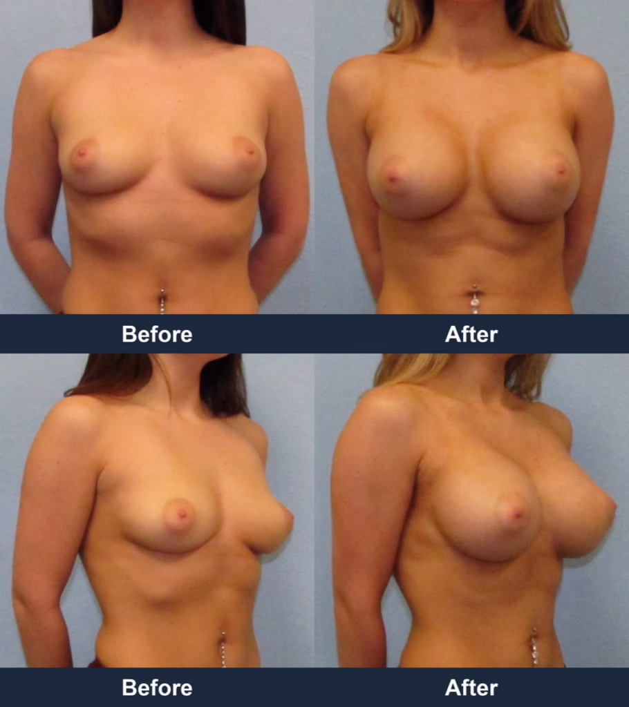 Breast Augmentation - Before and After Images with Dr. Chaudhari