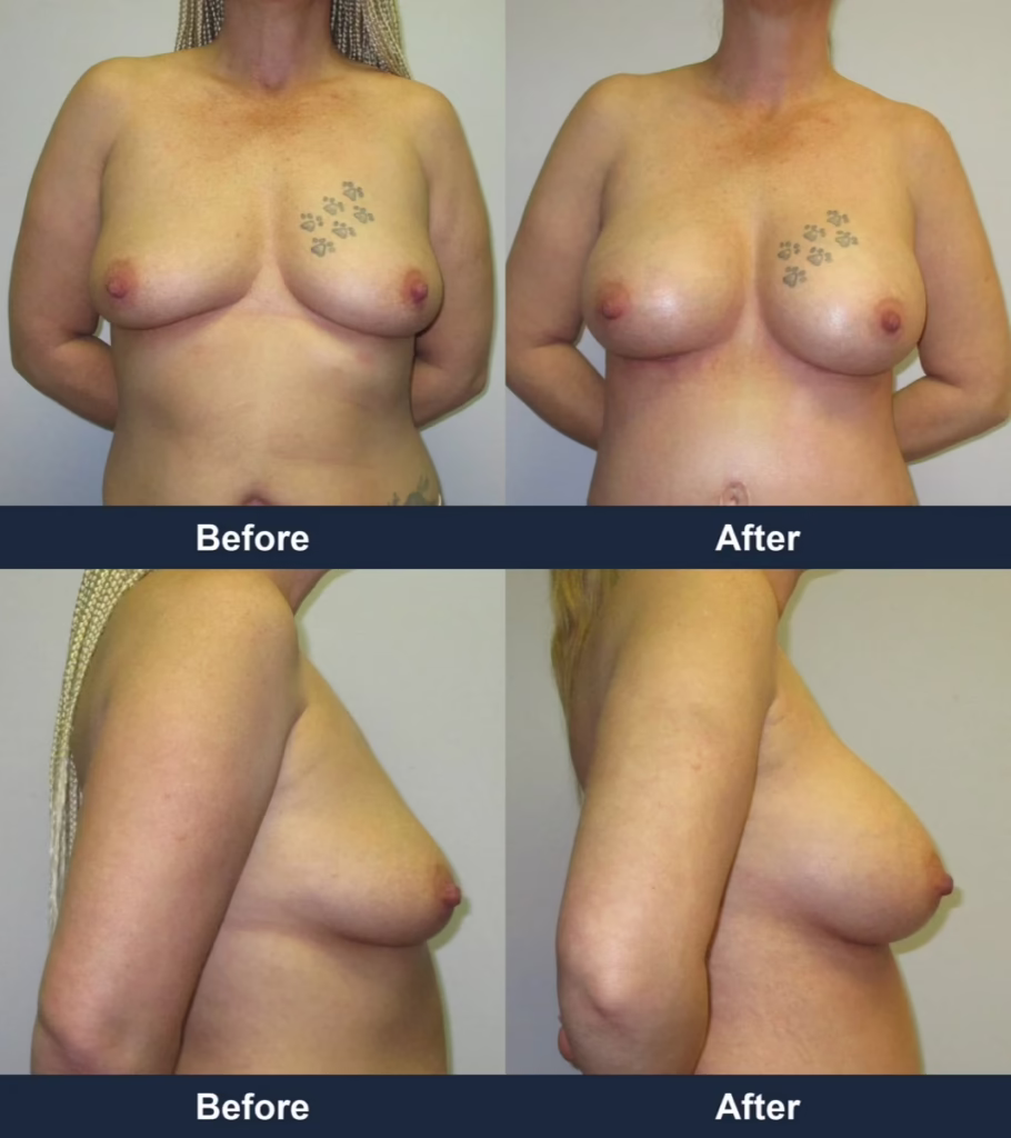 Breast Augmentation - Before and After Images with Dr. Chaudhari