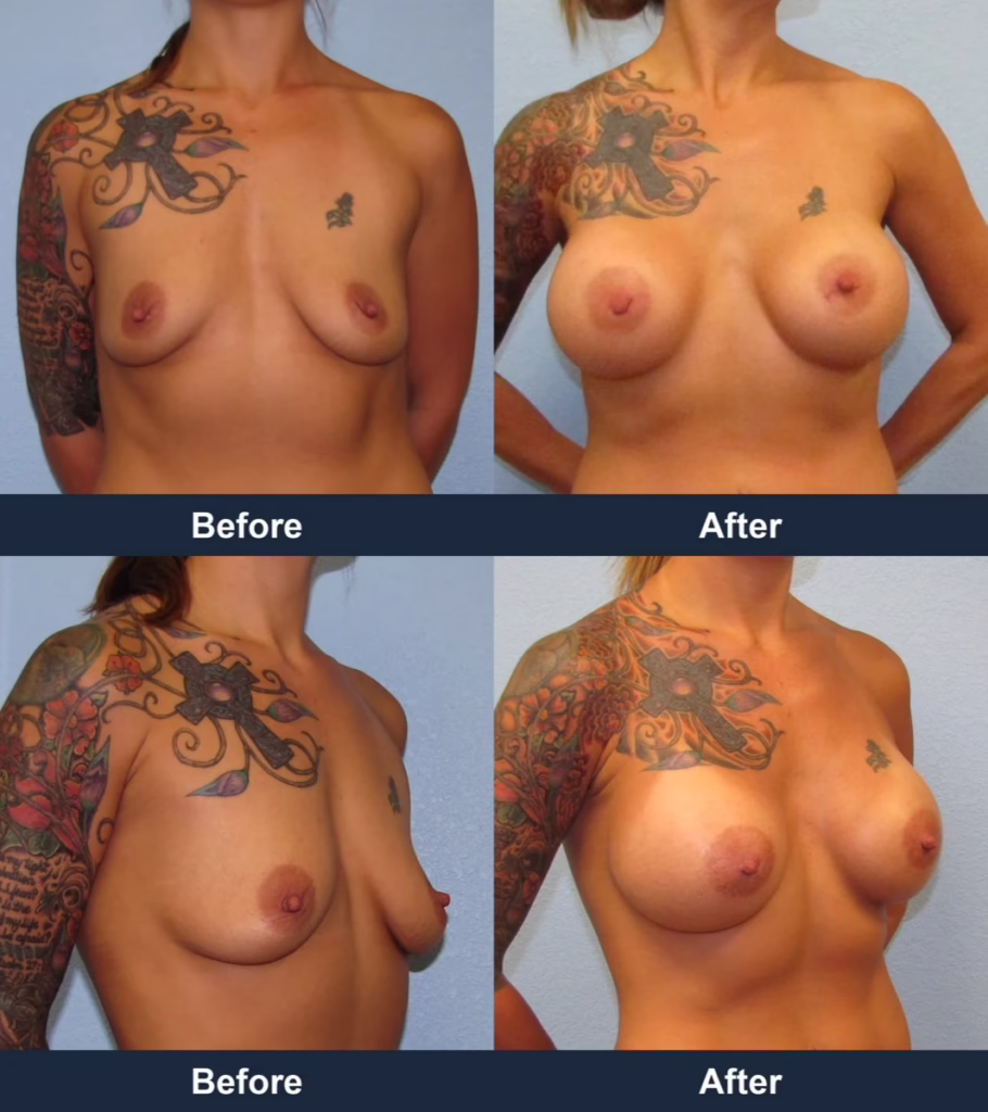 Breast Augmentation - Before and After Images with Dr. Chaudhari